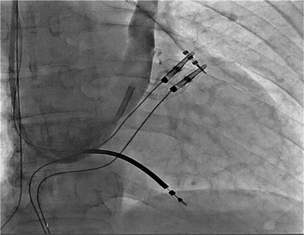 Figure 1. Visualization of the coronary sinus via the catheter inserted from the right subclavian puncture